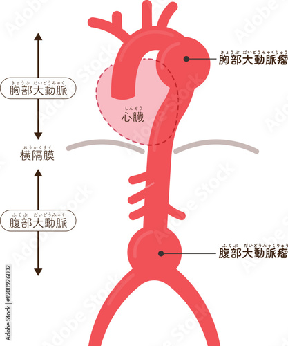 大動脈瘤のイラスト　Illustration of an aortic aneurysm