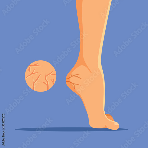  Foot with Cracked Heels Vector Medical Illustration. Damaged skin on barefoot person medical drawing
