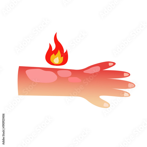 Burned skin. vector illustration design
