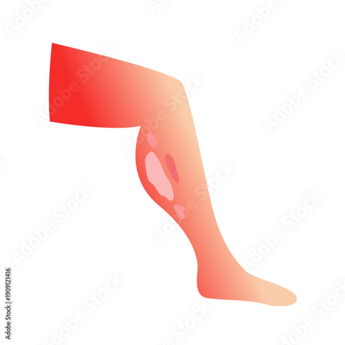 Burned skin. vector illustration design