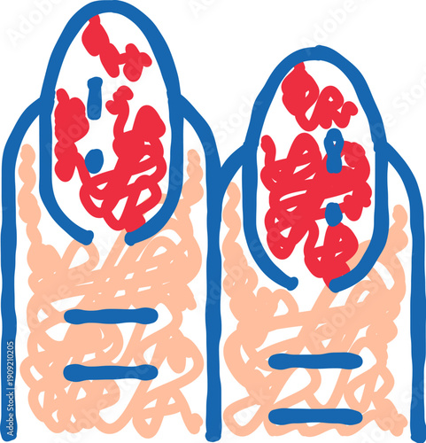 Psoriasis affecting fingernails, displaying skin irritation and redness, representing a dermatological health issue requiring medical treatment and diagnosis