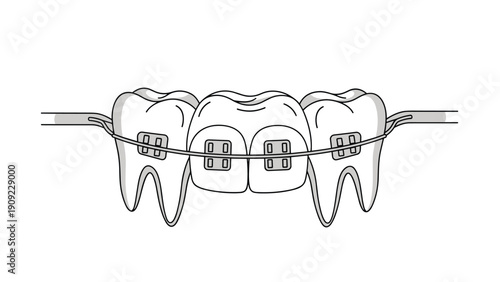Close up medical illustration of dental braces attached to teeth for orthodontic treatment and corrective dental alignment procedure.