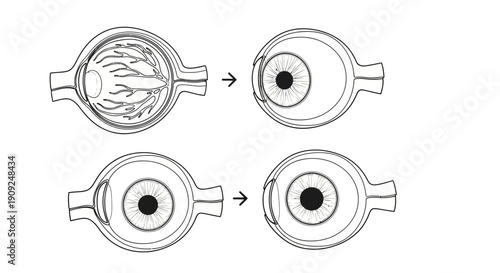 Eye Anatomy and Vision Correction: Myopia vs. Hyperopia Diagrams