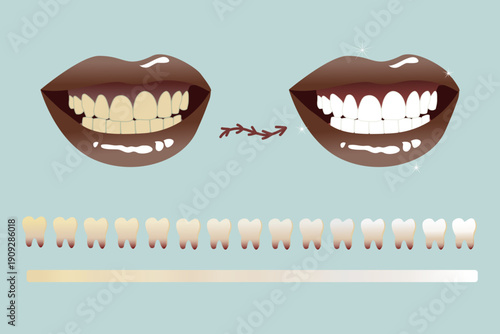 Professional Teeth Whitening Before and After Smile Comparison with Tooth Shade Scale – Cosmetic Dentistry Vector Illustration