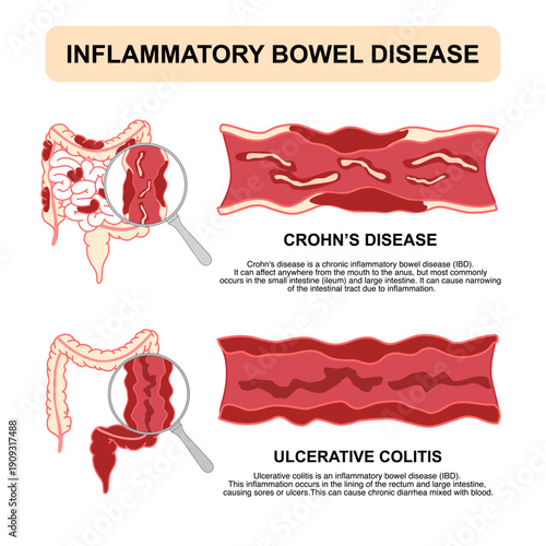 Illustration of inflammatory bowel disease. Crohn's disease and ulcerative colitis. Inflammation of the human digestive system. Flat vector illustration for medical, science, and educational posters.
