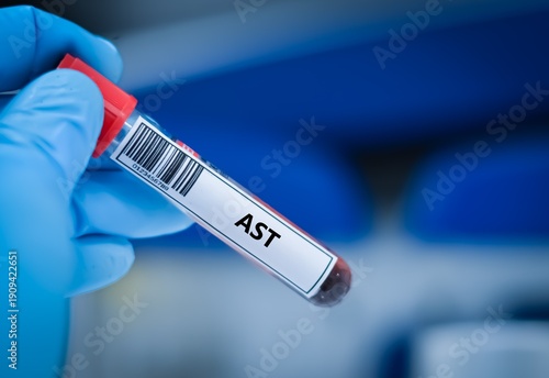 Blood sample tube for AST test analysis.