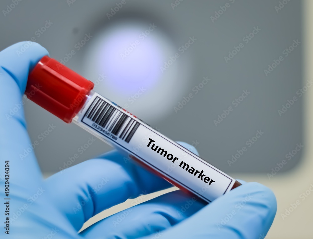 Naklejka premium Blood sample tube for tumor marker test analysis.