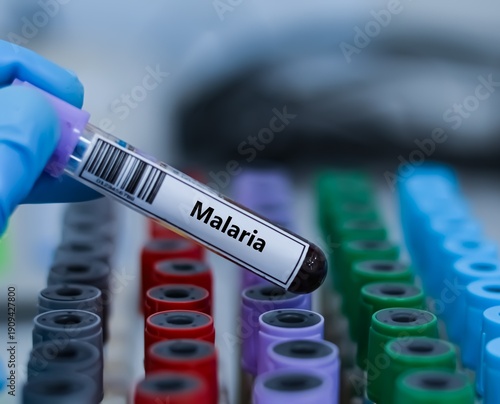 Slika na platnu Blood sample tube for malaria test analysis.