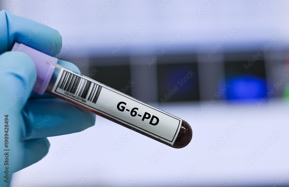 Fototapeta premium Blood sample tube for G-6-PD test analysis.