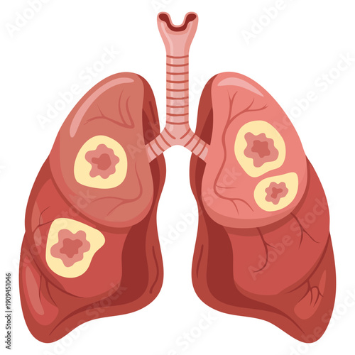 Respiratory disease concept flat design illustration showing lung cancer on white background perfect for health awareness poster banner and presentation use
