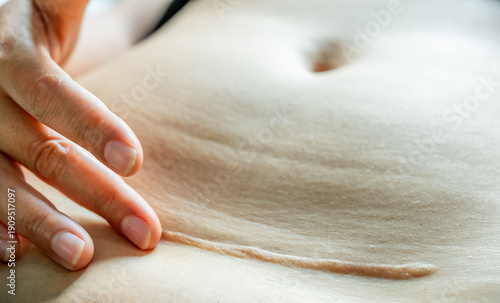 Cuadro en lienzo Close-up of a healed C-section scar on a woman's belly with a hand gently touching the skin
