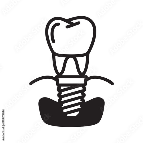 A dental implant with a tooth on top