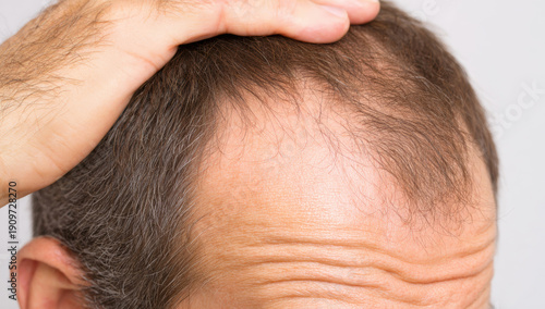 Young man observing his thinning hair and balding scalp, searching for solutions for hair loss and alopecia