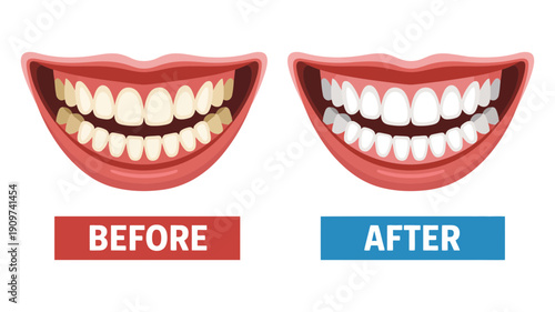 An illustrative comparison clearly displays the before and after effects of teeth whitening treatment.