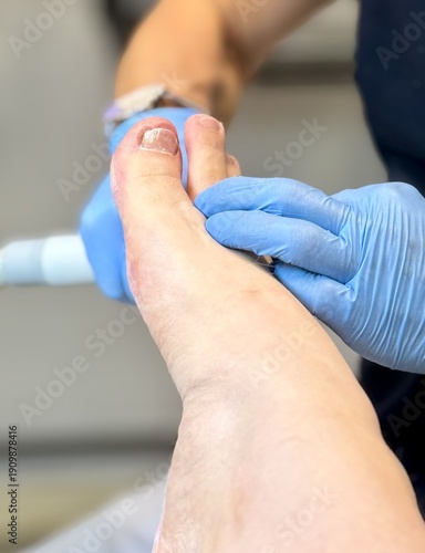 Doctor specializing in foot and nail diseases who treats gloved nails in clinical setting, removes the nail plate with an electric drill, pays special attention to diabetic foot care and sterility.