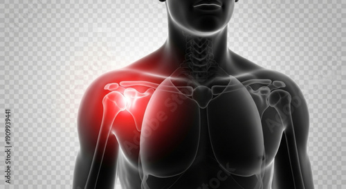 A medical illustration of a human body with a highlighted shoulder injury
