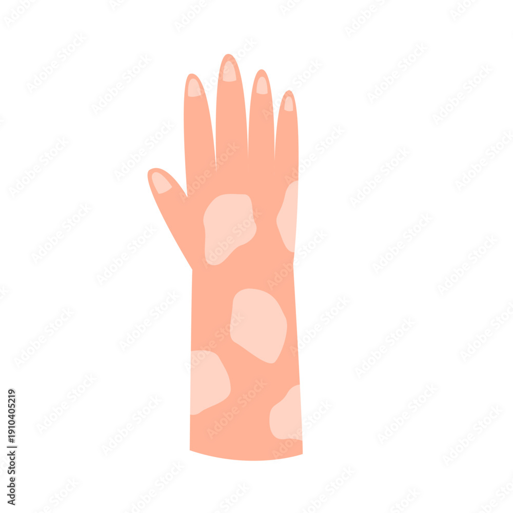 Obraz premium leprosy disease concept. vector illustration