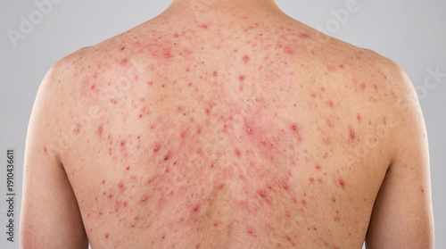 Medical image of severe acne on human back with inflamed pimples and redness. Dermatology healthcare concept, cropped body part, no face visible, non-sexual and educational.