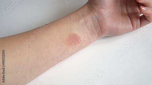 Fotografía Human hand with red skin burn on wrist
