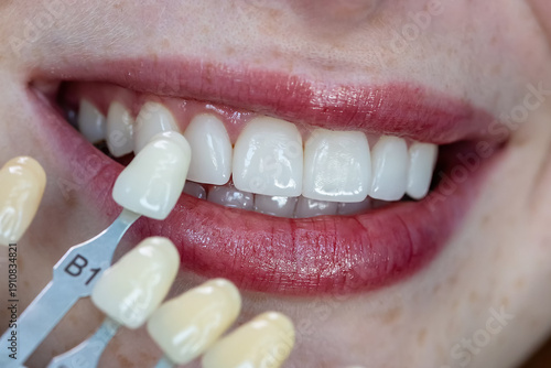 Bild auf Leinwand Shade selection for veneers or crowns using dental color guide near patient’s smile
