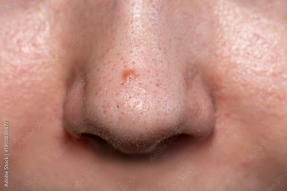 Fototapeta premium Close up of human nose with visible pores and blackheads. Macro dermatology photography of oily skin texture. Skincare and cosmetology concept. Design for banner, poster, wallpaper, header. Macro shot