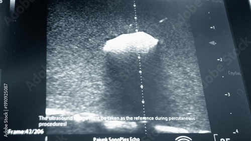 Ultrasound on monitor close-up. Ultrasound image on computer monitor screen. Ultrasound examination. Sonography sonogram. Monitoring diagnostic medical healthcare system. Ultrasonography ultrasonic.
