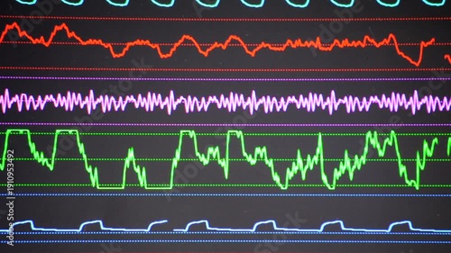 Modern patient monitor close-up. Electronic health monitor displaying medical indicators graphs of patient vital activity. Cardiogram ECG Pulse. Medical vital signs. Screen hospital computer monitor
