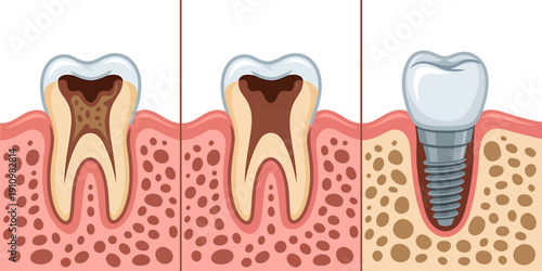 Dental implant procedure with healthy and decayed teeth comparison  tooth implant process