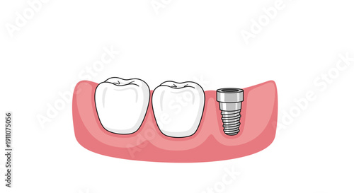 Two natural teeth are present in a gum line next to a visible dental implant screw awaiting a prosthetic crown.