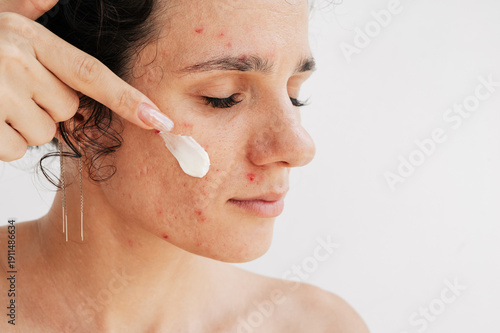 Wallpaper Mural The concept of dermatological skin care for a woman with acne applying a therapeutic cream Torontodigital.ca