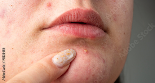 Photos Acne on skin closeup photo