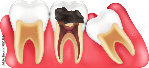 vector 3D medical illustration showing impacted wisdom tooth pushing healthy molar with inflamed red gums gingivitis professional dentistry education and healthcare marketing concept