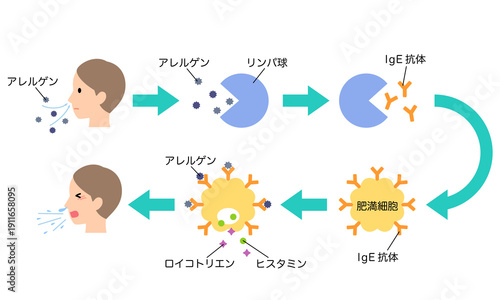 Tableau sur toile アレルギー発症のしくみ　花粉症のメカニズム