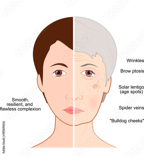 Photoaging. comparison of skin of young person and older skin.