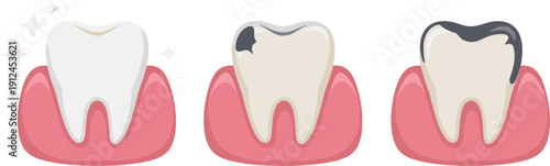 Tooth Decay Progression Illustration Showing Healthy Tooth, Early Cavity, and Severe Dental Caries Stages for Oral Health Education, Dentistry, and Medical Design