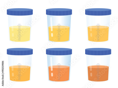 Different urine colors, medical urine test, various health conditions