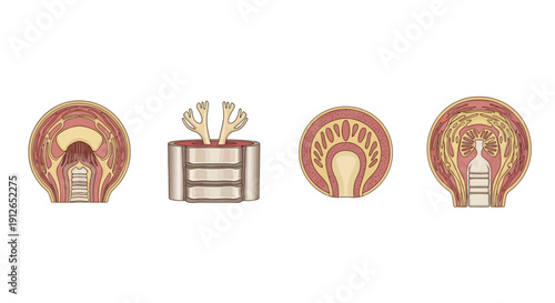 Cross-section of Human Prostate Gland Showing Different Stages of Benign Prostatic Hyperplasia (BPH)