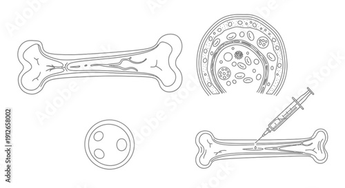 Bone Marrow Extraction and Injection Illustration: Medical Procedure