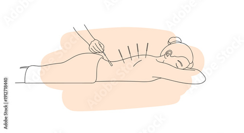 Line art illustration of a woman lying down on a treatment table receiving traditional chinese acupuncture therapy.