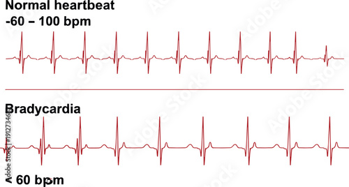 Comparison of normal heartbeat and bradycardia electrocardiogram waveforms showing different heart rhythm patterns.