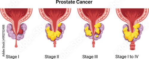 Prostate cancer stages infographic illustration showing Stage I, Stage II, Stage III and Stage I to IV progression, urology anatomy medical concept isolated on white background.