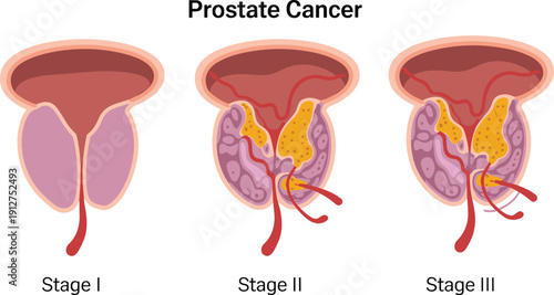 Prostate cancer stages medical infographic illustration showing Stage I, Stage II and Stage III progression, urology disease anatomy concept diagram isolated on white background.