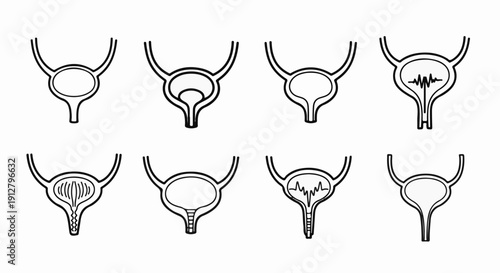 Anatomical illustrations of urinary bladders showing different internal conditions