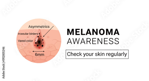 Melanoma awareness infographic showing skin cancer symptoms: asymmetry, irregular borders, varied color, and size over 6mm.