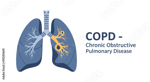 Medical illustration of human lungs showing Chronic Obstructive Pulmonary Disease (COPD) symptoms. Respiratory system health concept.
