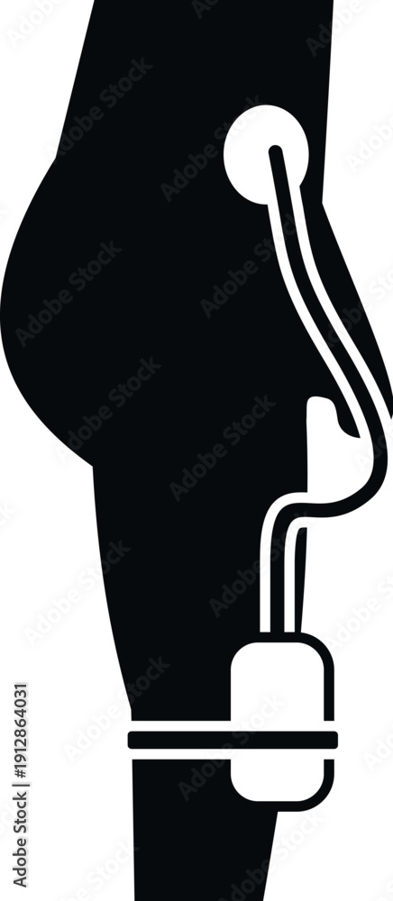 Fototapeta premium Persons torso and thigh with a catheter for peritoneal dialysis treatment