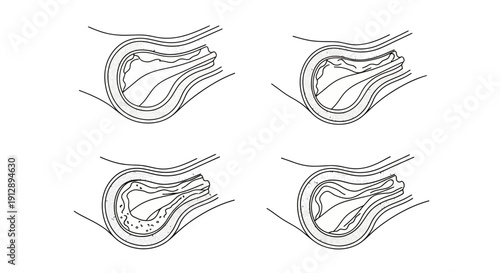 Medical Illustration of Atherosclerosis Progression in Arterial Plaque