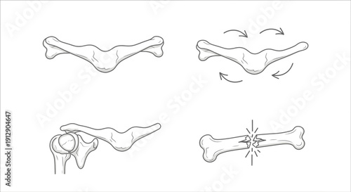 Clavicle Fracture Diagram: Anatomy, Injury, and Healing Stages