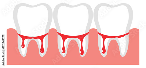 Modern illustration of bleeding gums depicting gingivitis for dental health awareness