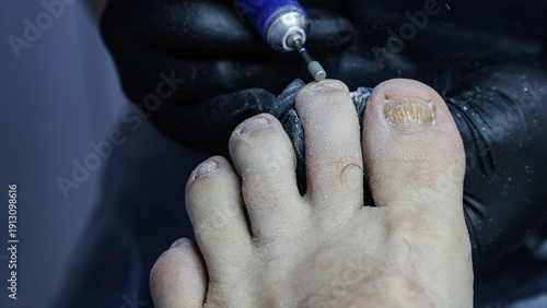 Foto Treatment of nails affected by nail fungus.